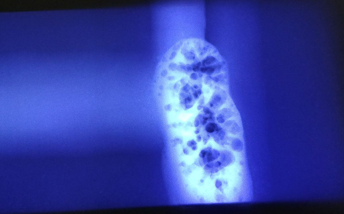 Filme radiográfico de junta soldada no negatoscópio mostrando porosidade agrupada no cordão de solda